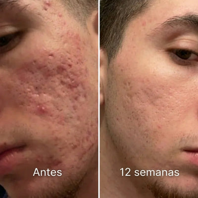 Barra de remodelación clínica de cicatrices de acné™