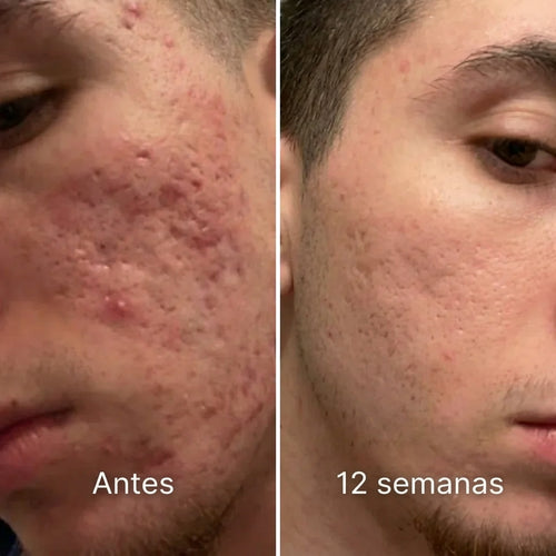 Barra de remodelación clínica de cicatrices de acné™